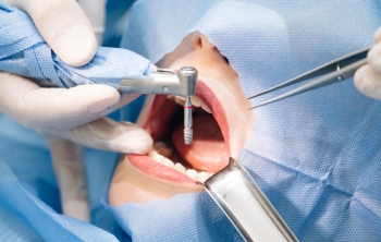 Implantes en Catarroja Implantologia